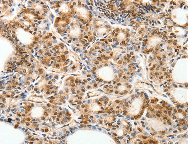 PDCD6 / ALG-2 Antibody - Immunohistochemistry of paraffin-embedded Human thyroid cancer using PDCD6 Polyclonal Antibody at dilution of 1:30.