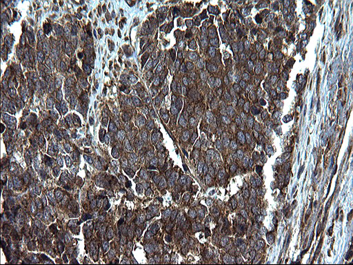 PDCD6IP / ALIX Antibody - IHC of paraffin-embedded Adenocarcinoma of Human colon tissue using anti-PDCD6IP mouse monoclonal antibody. (Heat-induced epitope retrieval by 1 mM EDTA in 10mM Tris, pH8.5, 120°C for 3min).