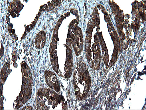 PDCD6IP / ALIX Antibody - IHC of paraffin-embedded Adenocarcinoma of Human ovary tissue using anti-PDCD6IP mouse monoclonal antibody. (Heat-induced epitope retrieval by 1 mM EDTA in 10mM Tris, pH8.5, 120°C for 3min).