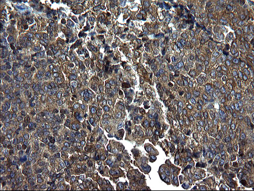 PDCD6IP / ALIX Antibody - IHC of paraffin-embedded Adenocarcinoma of Human endometrium tissue using anti-PDCD6IP mouse monoclonal antibody. (Heat-induced epitope retrieval by 1 mM EDTA in 10mM Tris, pH8.5, 120°C for 3min).