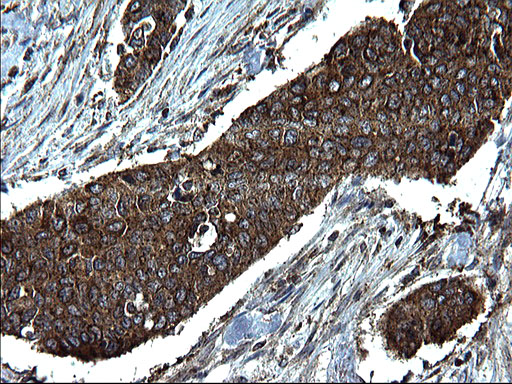 PDCD6IP / ALIX Antibody - IHC of paraffin-embedded Carcinoma of Human bladder tissue using anti-PDCD6IP mouse monoclonal antibody. (Heat-induced epitope retrieval by 1 mM EDTA in 10mM Tris, pH8.5, 120°C for 3min).