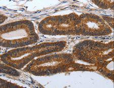 PDCD7 Antibody - Immunohistochemistry of paraffin-embedded Human lung cancer using PDCD7 Polyclonal Antibody at dilution of 1:60.