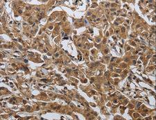 PDCD7 Antibody - Immunohistochemistry of paraffin-embedded Human ovarian cancer using PDCD7 Polyclonal Antibody at dilution of 1:60.