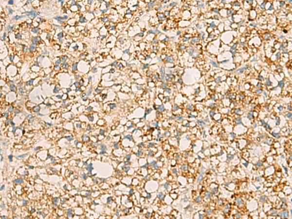 PDCL Antibody - Immunohistochemistry of paraffin-embedded Human liver cancer tissue  using PDCL Polyclonal Antibody at dilution of 1:40(×200)