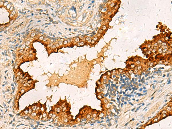 PDCL Antibody - Immunohistochemistry of paraffin-embedded Human prost ate cancer tissue  using PDCL Polyclonal Antibody at dilution of 1:40(×200)