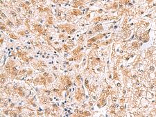 PDCL2 Antibody - Immunohistochemistry of paraffin-embedded Human liver cancer tissue  using PDCL2 Polyclonal Antibody at dilution of 1:65(×200)