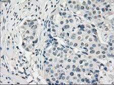PDE10A Antibody - IHC of paraffin-embedded Adenocarcinoma of breast tissue using anti-PDE10A mouse monoclonal antibody. (Dilution 1:50).