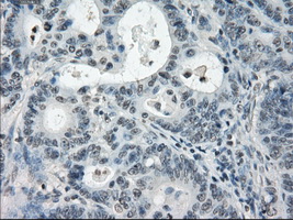 PDE10A Antibody - IHC of paraffin-embedded Adenocarcinoma of colon tissue using anti-PDE10A mouse monoclonal antibody. (Dilution 1:50).