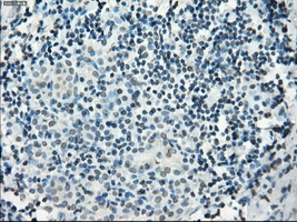 PDE10A Antibody - IHC of paraffin-embedded Carcinoma of thyroid tissue using anti-PDE10A mouse monoclonal antibody. (Dilution 1:50).