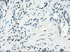PDE10A Antibody - IHC of paraffin-embedded Carcinoma of prostate tissue using anti-PDE10A mouse monoclonal antibody. (Dilution 1:50).
