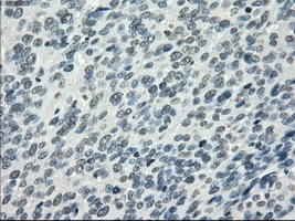 PDE10A Antibody - IHC of paraffin-embedded Carcinoma of bladder tissue using anti-PDE10A mouse monoclonal antibody. (Dilution 1:50).