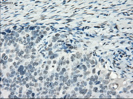 PDE10A Antibody - IHC of paraffin-embedded Adenocarcinoma of ovary tissue using anti-PDE10A mouse monoclonal antibody. (Dilution 1:50).