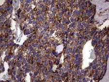 PDE1A Antibody - IHC of paraffin-embedded Adenocarcinoma of Human breast tissue using anti-PDE1A mouse monoclonal antibody. (Heat-induced epitope retrieval by 1 mM EDTA in 10mM Tris, pH8.5, 120°C for 3min).