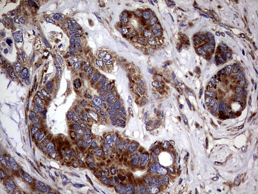 PDE1A Antibody - IHC of paraffin-embedded Adenocarcinoma of Human colon tissue using anti-PDE1A mouse monoclonal antibody. (Heat-induced epitope retrieval by 1 mM EDTA in 10mM Tris, pH8.5, 120°C for 3min).