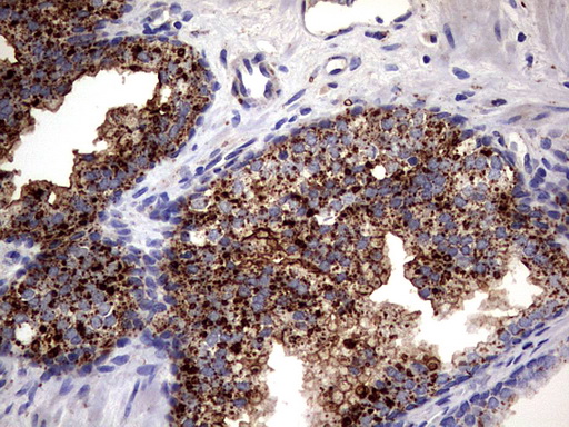 PDE1A Antibody - IHC of paraffin-embedded Carcinoma of Human prostate tissue using anti-PDE1A mouse monoclonal antibody. (Heat-induced epitope retrieval by 1 mM EDTA in 10mM Tris, pH8.5, 120°C for 3min).