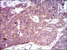 PDE1B Antibody - IHC of paraffin-embedded ovarian cancer tissues using PDE1B mouse monoclonal antibody with DAB staining.