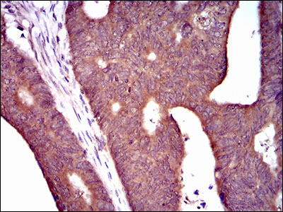 PDE1B Antibody - IHC of paraffin-embedded rectum cancer tissues using PDE1B mouse monoclonal antibody with DAB staining.