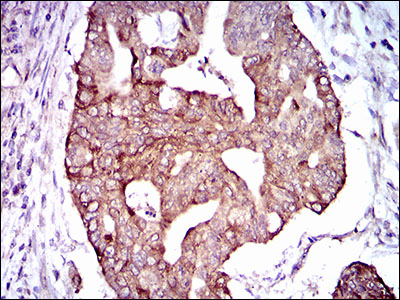 PDE1B Antibody - IHC of paraffin-embedded rectum cancer tissues using PDE1B mouse monoclonal antibody with DAB staining.