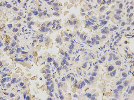 PDE1B Antibody - Immunohistochemistry of paraffin-embedded human kidney cancer using PDE1B antibody at dilution of 1:200 (200x lens).