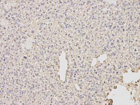 PDE1B Antibody - Immunohistochemistry of paraffin-embedded human lung cancer using PDE1B antibody at dilution of 1:200 (400x lens).