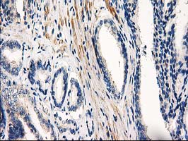 PDE2A Antibody - IHC of paraffin-embedded Carcinoma of Human prostate tissue using anti-PDE2A mouse monoclonal antibody.