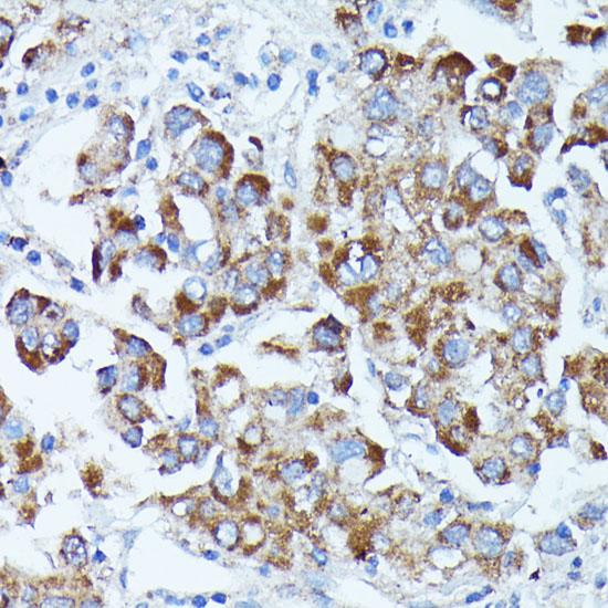 PDE3A Antibody - Immunohistochemistry of paraffin-embedded Human liver cancer using PDE3A Polyclonal Antibody at dilution of 1:100 (40x lens).