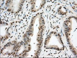 PDE4A / PDE4 Antibody - Immunohistochemical staining of paraffin-embedded Adenocarcinoma of Human colon tissue using anti-PDE4A mouse monoclonal antibody. (Dilution 1:50).