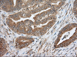 PDE4A / PDE4 Antibody - IHC of paraffin-embedded Adenocarcinoma of Human colon tissue using anti-PDE4A mouse monoclonal antibody. (Dilution 1:50).