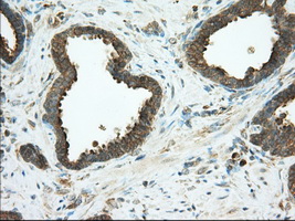 PDE4A / PDE4 Antibody - IHC of paraffin-embedded Carcinoma of Human prostate tissue using anti-PDE4A mouse monoclonal antibody. (Dilution 1:50).