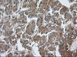 PDE4A / PDE4 Antibody - IHC of paraffin-embedded Carcinoma of Human liver tissue using anti-PDE4A mouse monoclonal antibody. (Dilution 1:50).