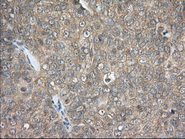 PDE4A / PDE4 Antibody - IHC of paraffin-embedded Adenocarcinoma of Human ovary tissue using anti-PDE4A mouse monoclonal antibody. (Dilution 1:50).