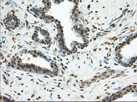 PDE4A / PDE4 Antibody - Immunohistochemical staining of paraffin-embedded Carcinoma of Human prostate tissue using anti-PDE4A mouse monoclonal antibody. (Dilution 1:50).