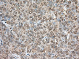 PDE4A / PDE4 Antibody - Immunohistochemical staining of paraffin-embedded Adenocarcinoma of Human ovary tissue using anti-PDE4A mouse monoclonal antibody. (Dilution 1:50).