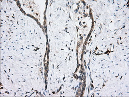 PDE4A / PDE4 Antibody - IHC of paraffin-embedded Carcinoma of Human prostate tissue using anti-PDE4A mouse monoclonal antibody. (Dilution 1:50).