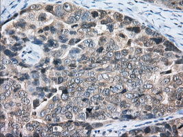 PDE4A / PDE4 Antibody - IHC of paraffin-embedded Adenocarcinoma of Human ovary tissue using anti-PDE4A mouse monoclonal antibody. (Dilution 1:50).