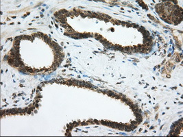 PDE4A / PDE4 Antibody - Immunohistochemical staining of paraffin-embedded Carcinoma of Human prostate tissue using anti-PDE4A mouse monoclonal antibody. (Dilution 1:50).