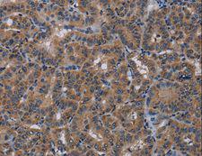 PDE4A / PDE4 Antibody - Immunohistochemistry of paraffin-embedded Human thyroid cancer using PDE4A Polyclonal Antibody at dilution of 1:40.