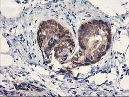 PDE4B Antibody - IHC of paraffin-embedded Adenocarcinoma of Human breast tissue using anti-PDE4B mouse monoclonal antibody.