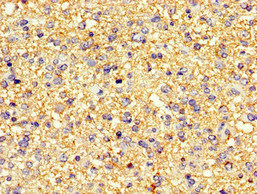 PDE4B Antibody - Immunohistochemistry image of paraffin-embedded human glioma cancer at a dilution of 1:100
