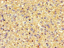 PDE4B Antibody - Immunohistochemistry image of paraffin-embedded human glioma cancer at a dilution of 1:100