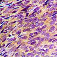 PDE4B+C+D Antibody - Immunohistochemical analysis of PDE4B/C/D staining in human breast cancer formalin fixed paraffin embedded tissue section. The section was pre-treated using heat mediated antigen retrieval with sodium citrate buffer (pH 6.0). The section was then incubated with the antibody at room temperature and detected using an HRP conjugated compact polymer system. DAB was used as the chromogen. The section was then counterstained with hematoxylin and mounted with DPX.
