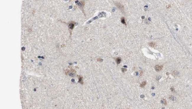 PDE4B+C+D Antibody - 1:100 staining human brain carcinoma tissue by IHC-P. The sample was formaldehyde fixed and a heat mediated antigen retrieval step in citrate buffer was performed. The sample was then blocked and incubated with the antibody for 1.5 hours at 22°C. An HRP conjugated goat anti-rabbit antibody was used as the secondary.