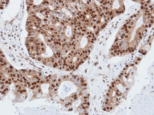 PDE4C Antibody - IHC of paraffin-embedded endo mitral using PDE4C antibody at 1:100 dilution.