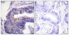PDE4D Antibody - Immunohistochemistry analysis of paraffin-embedded human colon carcinoma tissue, using PDE4D Antibody. The picture on the right is blocked with the synthesized peptide.