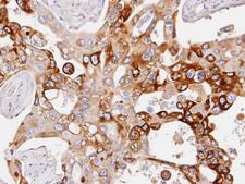 PDE4D Antibody - IHC of paraffin-embedded H441 xenograft using PDE4D antibody at 1:100 dilution.