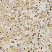 PDE4D Antibody - Immunohistochemistry of paraffin-embedded human kidney cancer using PDE4D antibody at dilution of 1:200 (x400 lens).