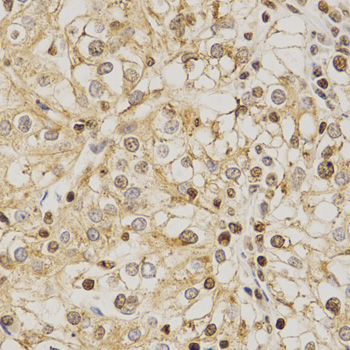 PDE4D Antibody - Immunohistochemistry of paraffin-embedded human kidney cancer using PDE4D antibody at dilution of 1:200 (x400 lens).