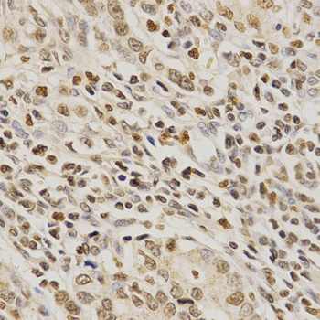 PDE4D Antibody - Immunohistochemistry of paraffin-embedded human stomach cancer using PDE4D antibody at dilution of 1:200 (x400 lens).