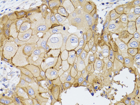 PDE4D Antibody - Immunohistochemistry of paraffin-embedded human breast cancer using PDE4D antibodyat dilution of 1:100 (40x lens).