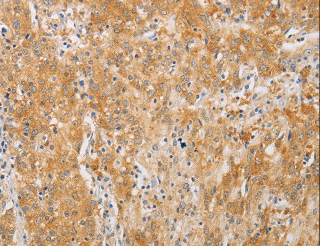 PDE4D Antibody - Immunohistochemistry of paraffin-embedded Human gastric cancer using PDE4D Polyclonal Antibody at dilution of 1:20.
